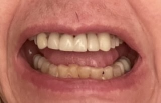 mouth lower arch