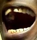 mouth right side