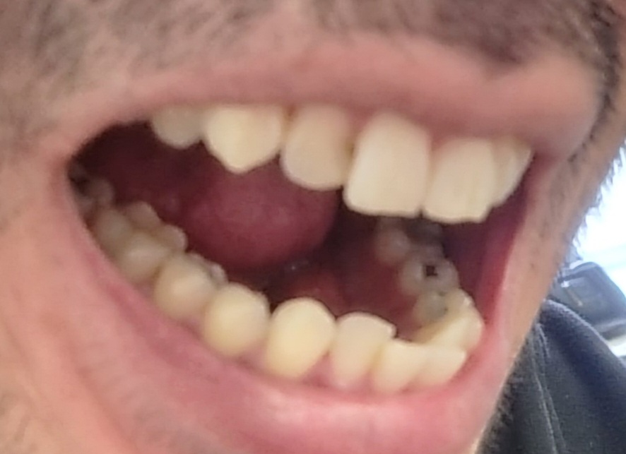 mouth left side