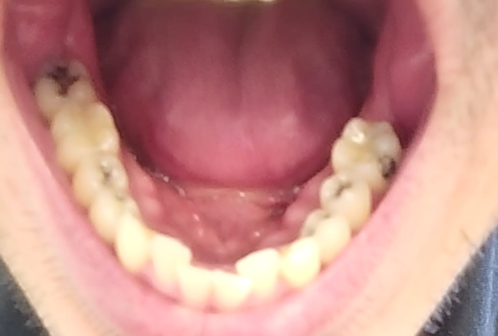 mouth lower arch