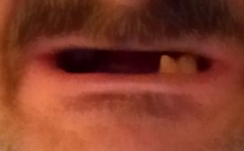 mouth left side
