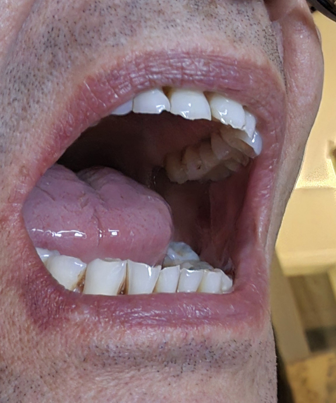 mouth left side